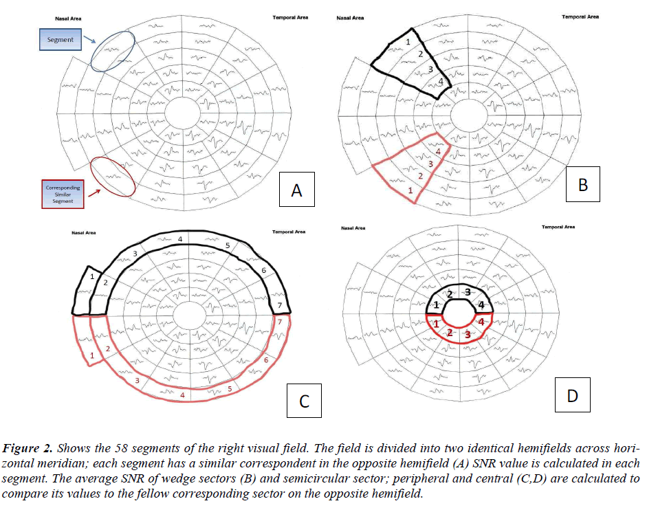 Perimetry Chart Interpretation