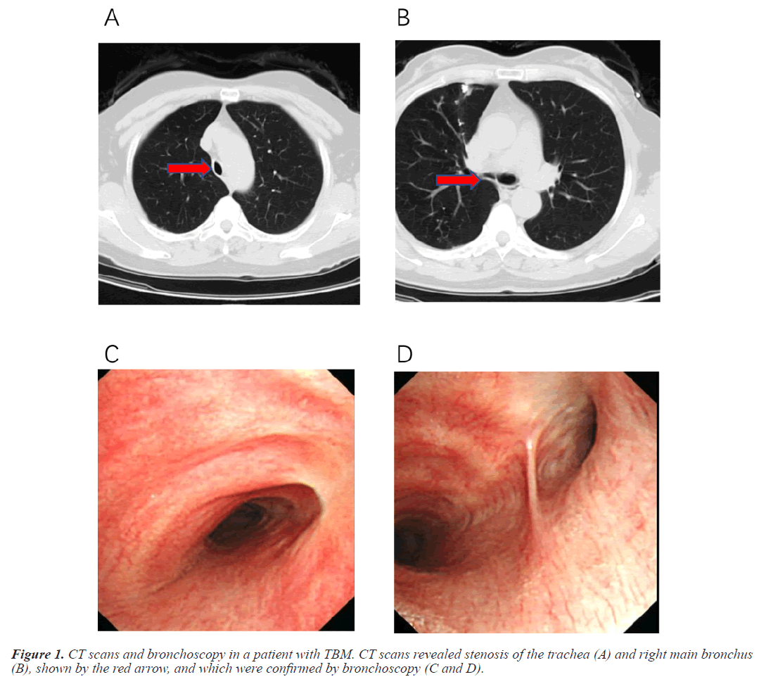 bronchoscopy