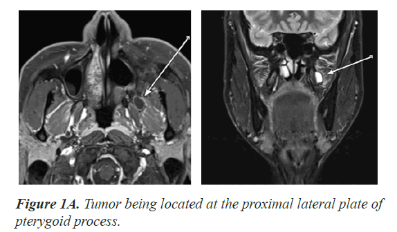 biomedical-research-Tumor