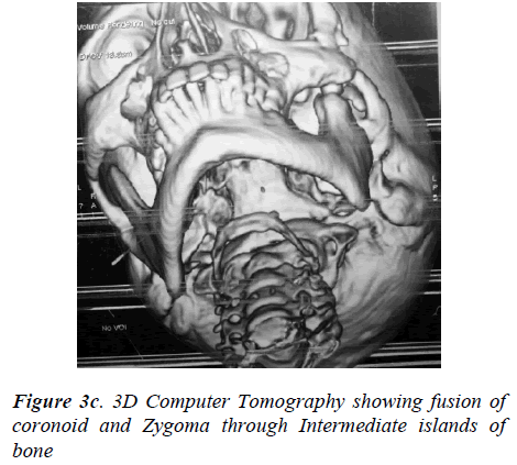 biomedres-3D-Computer-Tomography-showing-fusion-coronoid