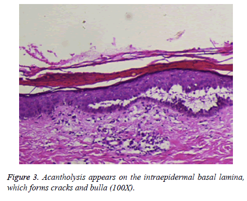 biomedres-Acantholysis-appears