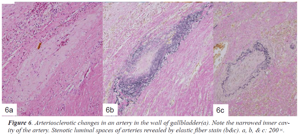 biomedres-Arteriosclerotic-changes-artery