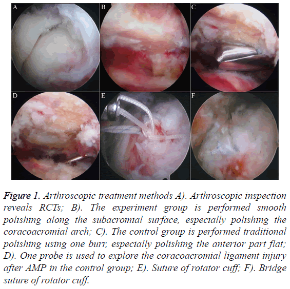 biomedres-Arthroscopic-treatment-methods