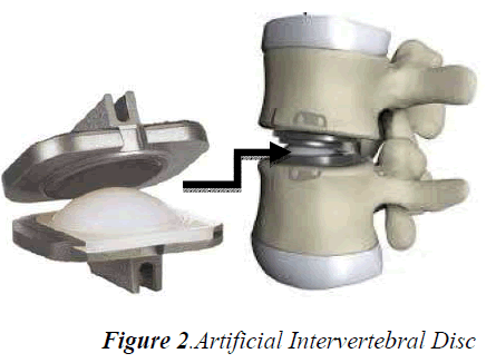 biomedres-Artificial-Intervertebral