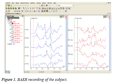 biomedres-BAER-recording-subject