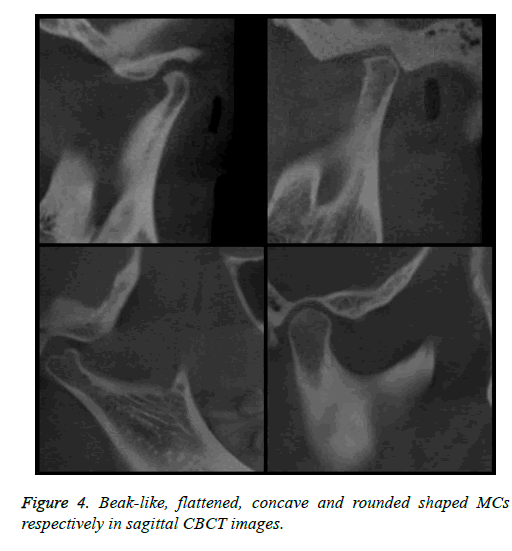 biomedres-Beak-like-concave