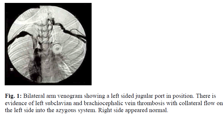 biomedres-Bilateral-arm-venogram