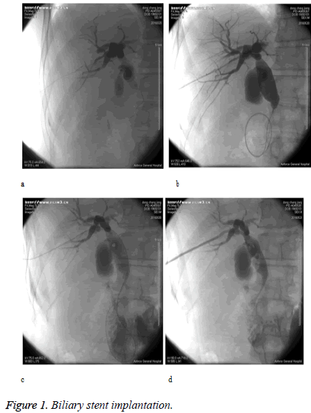 biomedres-Biliary-stent