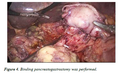 biomedres-Binding-pancreatogastrostomy