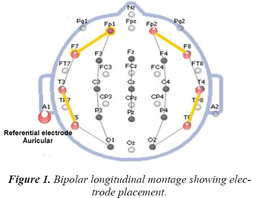 biomedres-Bipolar-longitudinal-montage