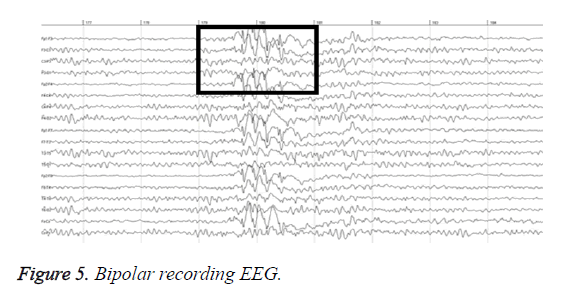 biomedres-Bipolar-recording-EEG