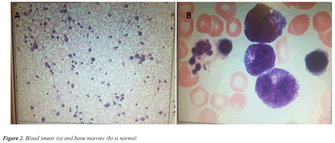 biomedres-Blood-smear-bone-marrow