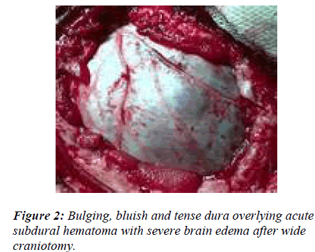 biomedres-Bulging-bluish-tense