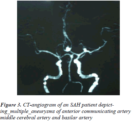 biomedres-CT-angiogram-SAH-patient