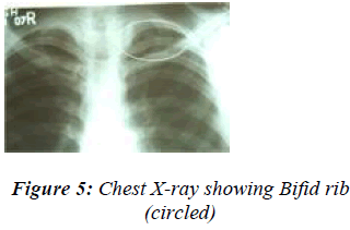 biomedres-Chest-X-ray-showing-Bifid-rib