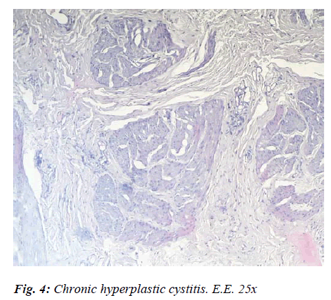 biomedres-Chronic-hyperplastic