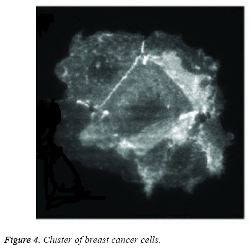 biomedres-Cluster-breast-cancer