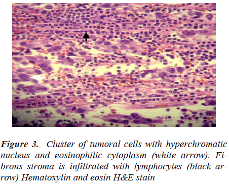 biomedres-Cluster-tumoral-cells-hyperchromatic