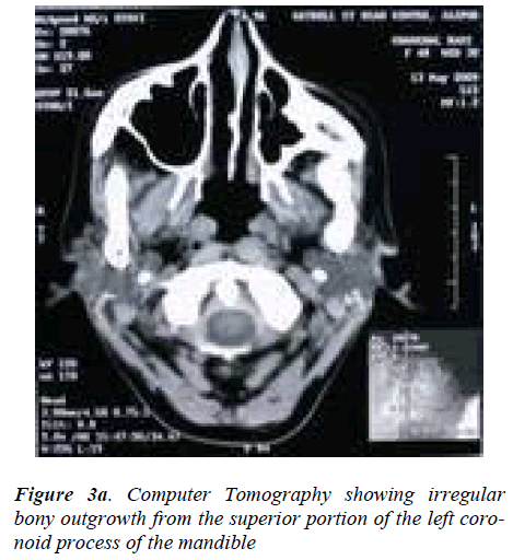 biomedres-Computer-Tomography-showing-irregular-bony-outgrowth