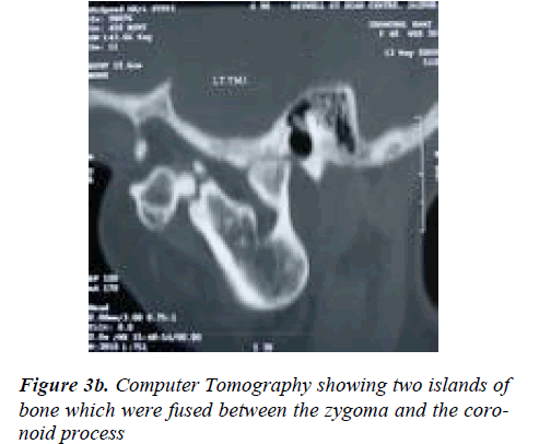 biomedres-Computer-Tomography-showing-two-islands-bone