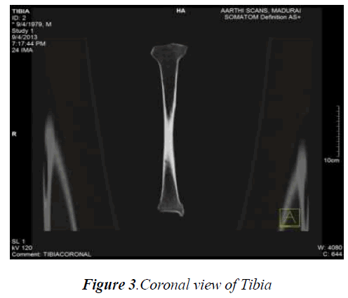 biomedres-Coronal-Tibia