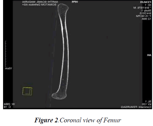 biomedres-Coronal-view-Femur