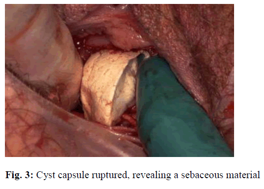 biomedres-Cyst-capsule-ruptured