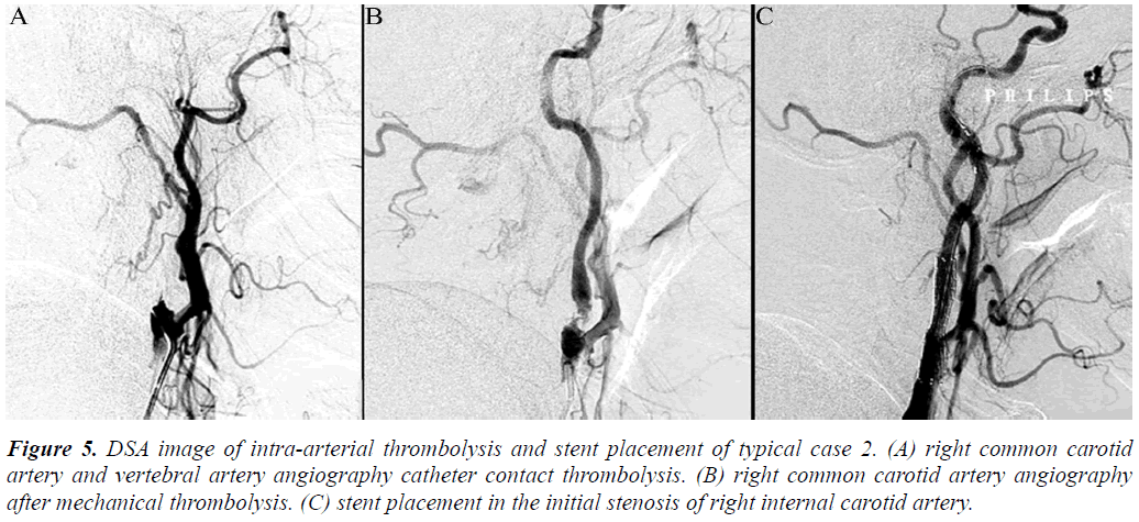 biomedres-DSA-image-intra-arterial