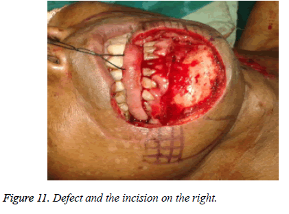 biomedres-Defect-right