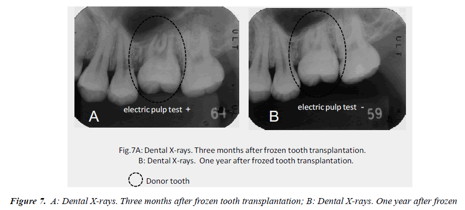 biomedres-Dental-X-rays-frozen-tooth