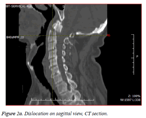 biomedres-Dislocation-sagittal