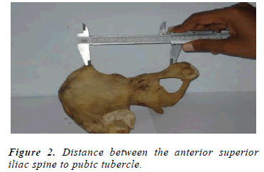 biomedres-Distance-pubic-tubercle