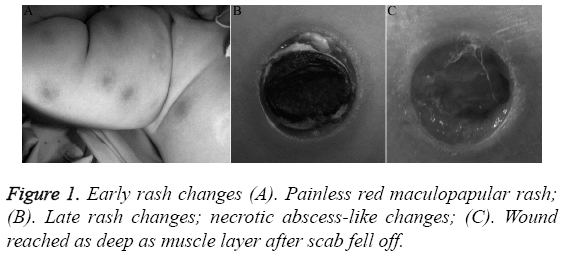 biomedres-Early-rash-changes