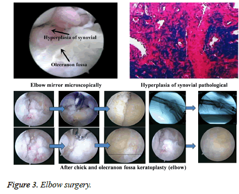 biomedres-Elbow-surgery