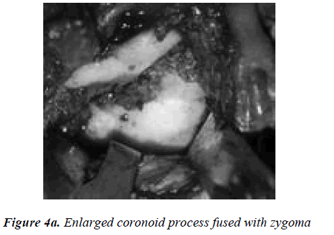 biomedres-Enlarged-coronoid-process-fused-zygoma