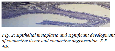 biomedres-Epithelial-metaplasia