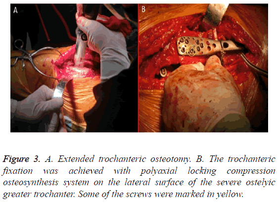 biomedres-Extended-trochanteric