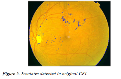 biomedres-Exudates-detected