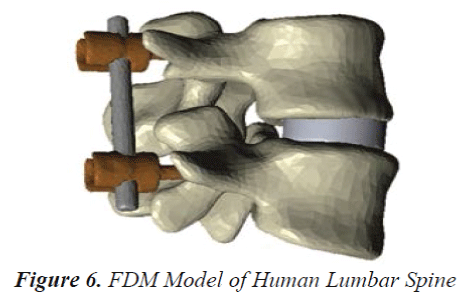 biomedres-FDM-Human-Lumbar-Spine