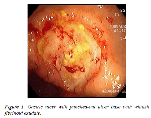 biomedres-Gastric-ulcer