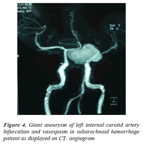 biomedres-Giant-aneurysm-carotid-artery