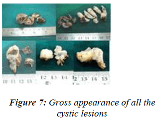 biomedres-Gross-appearance-all-cystic-lesions