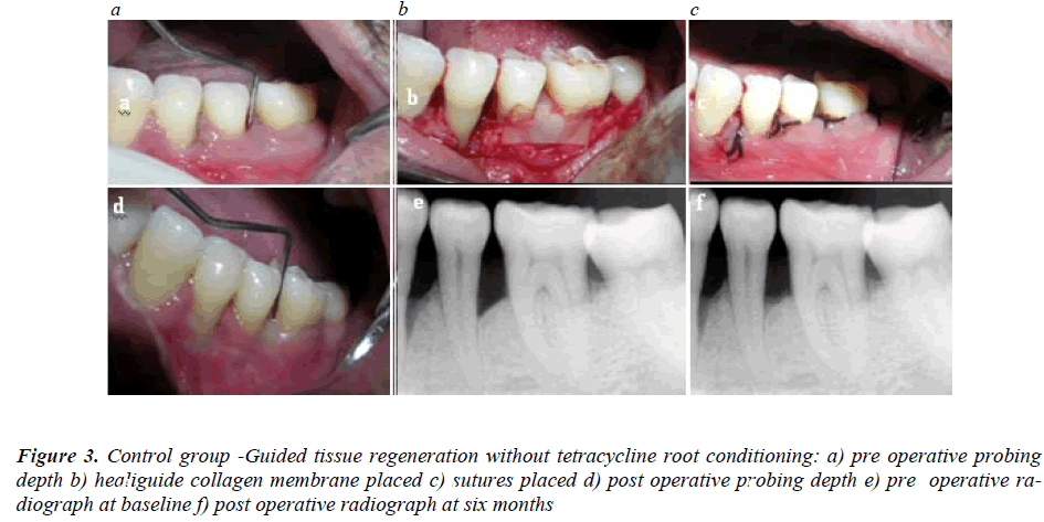 biomedres-Guided-tissue-regeneration