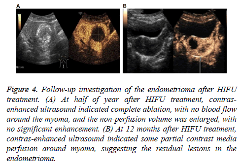 biomedres-HIFU-treatment