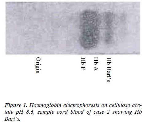 biomedres-Haemoglobin-electrophoresis