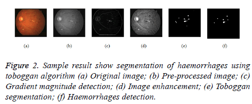 biomedres-Haemorrhages-segmentation