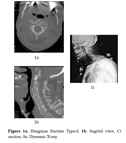 biomedres-Hangman-fracture