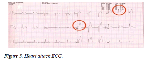 biomedres-Heart-attack