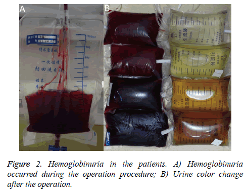 biomedres-Hemoglobinuria