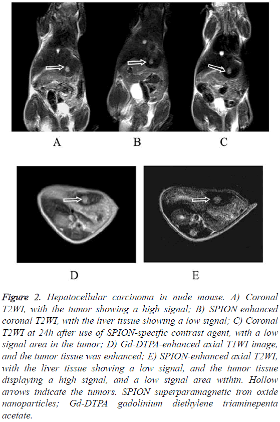 biomedres-Hepatocellular-carcinoma-nude